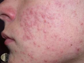 Acne, Rosacea, and Other Acneiform Conditions