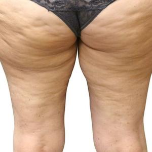 Cellulite Treatment and Symptoms Triage