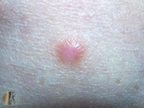 Dermatofibroma hotsell