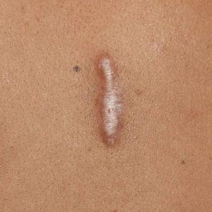 Symptoms of Keloid Scars and Treatment Options